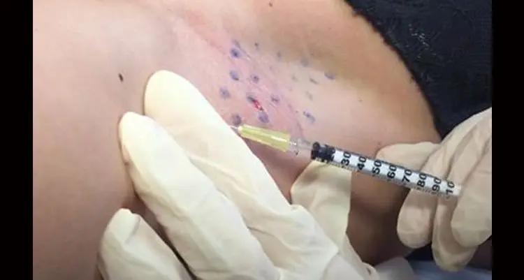 botox-ascelle